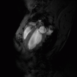 MRI image of heart